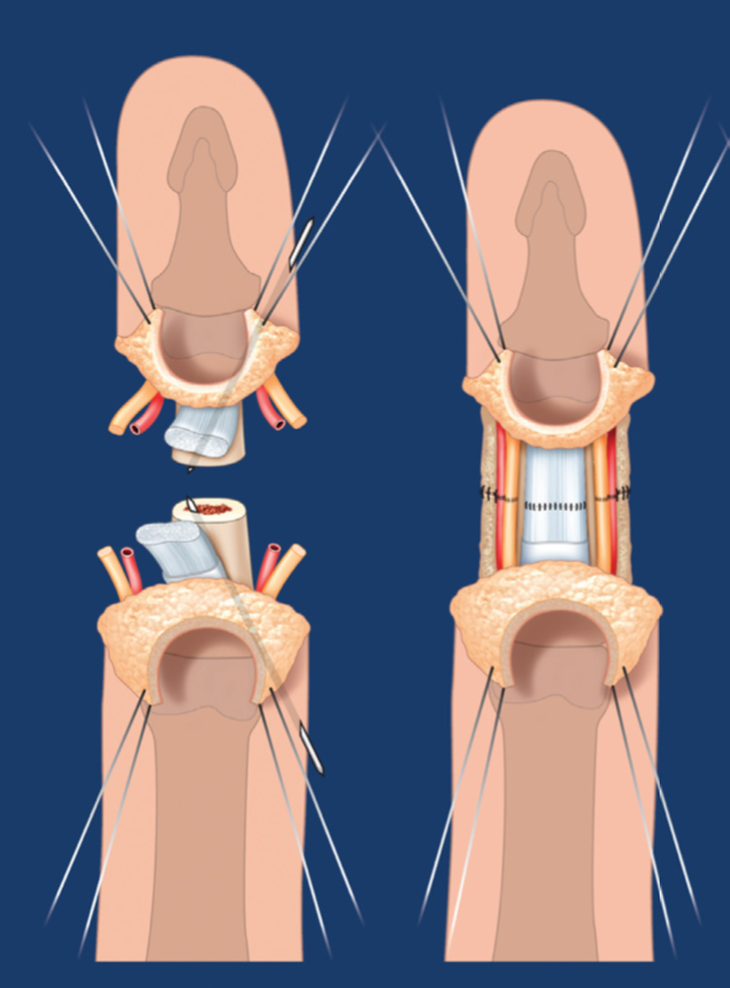 Microchirurgia a reușit să reatașeze degetul secționat după 25 de ore - Fotografia 2. Vi phẫu thuật nối thành công ngón tay của thủy thủ tàu viễn dương bị đứt rời sau 25 giờ - Ảnh 2.