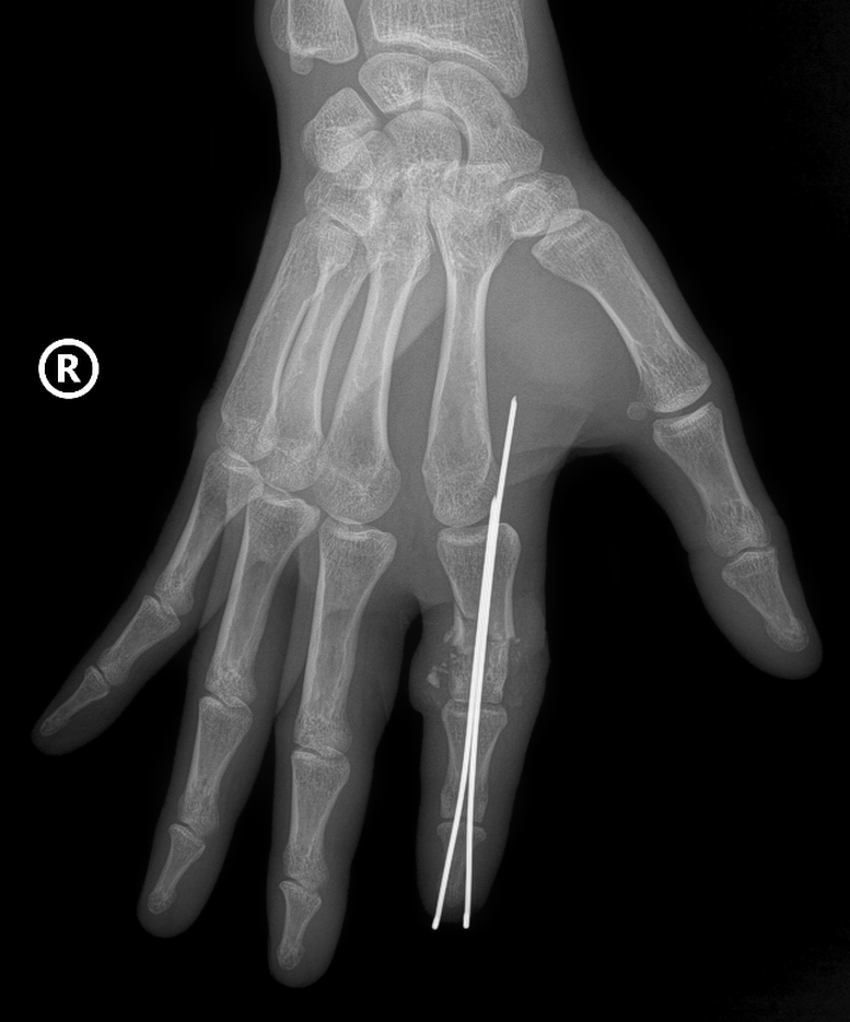 Vi phẫu thành công cứu sống ngón tay thủy thủ bị đứt rời sau 25 giờ- Ảnh 1.