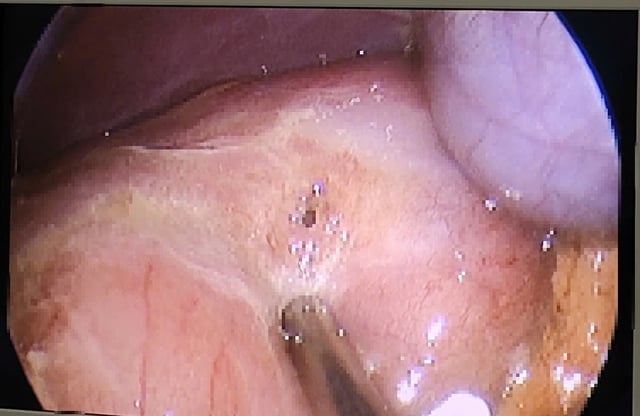 Cirurgia de emergência em paciente de 13 anos com úlcera gástrica perfurada e alerta do médico - Foto 1. Phẫu thuật cấp cứu bệnh nhi 13 tuổi bị thủng ổ loét dạ dày – tá tràng và lời cảnh tỉnh từ bác sĩ- Ảnh 1.