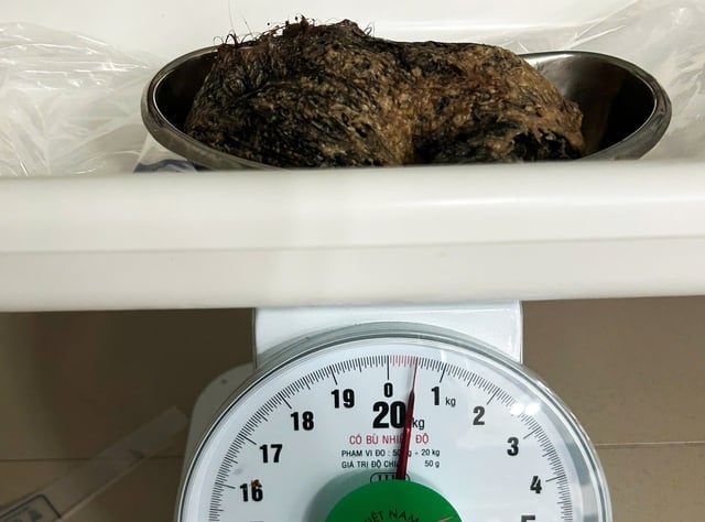 Et halvt kilo hår i magen til en 6 år gammel jente - Bilde 2. Nửa cân tóc trong dạ dày bé gái 6 tuổi - Ảnh 2.