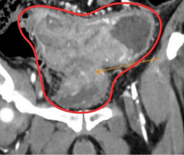 Chọn thuốc nam thay mổ, bệnh nhân ung thư chuyển nặng sau 6 tháng - Ảnh 1.