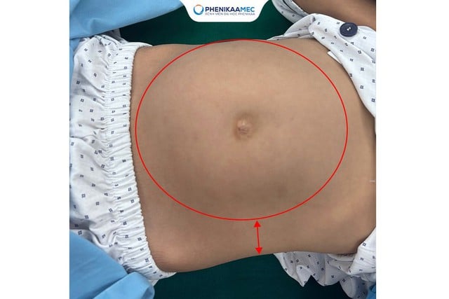 Phenikaa a efectuat cu succes o intervenție chirurgicală la o fetiță de 9 ani cu un teratom ovarian de 20 cm, păstrându-i fertilitatea - Foto 1. Phenikaa phẫu thuật thành công cho bé gái 9 tuổi mắc u quái buồng trứng 20 cm, bảo toàn khả năng sinh sản- Ảnh 1.