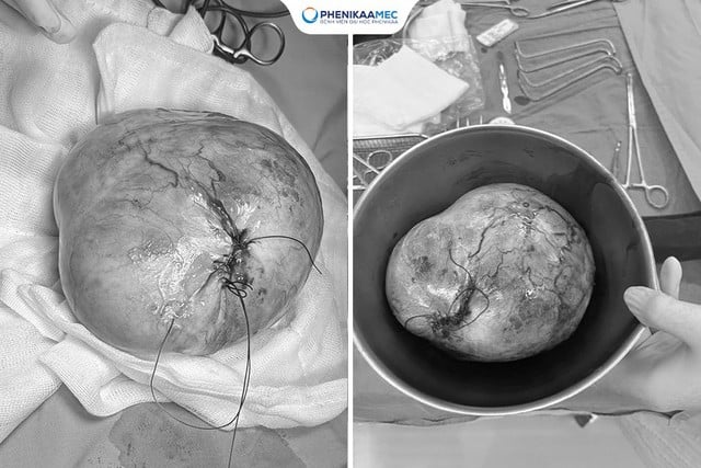 Phenikaa a efectuat cu succes o intervenție chirurgicală la o fetiță de 9 ani cu un teratom ovarian de 20 cm, păstrându-i fertilitatea - Foto 2. Phenikaa phẫu thuật thành công cho bé gái 9 tuổi mắc u quái buồng trứng 20 cm, bảo toàn khả năng sinh sản- Ảnh 2.