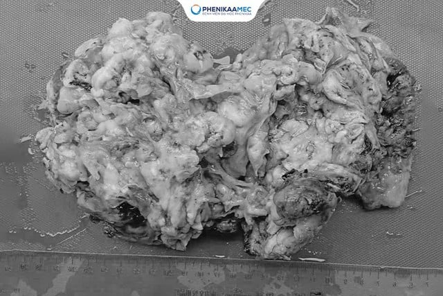 Phenikaa a efectuat cu succes o intervenție chirurgicală la o fetiță de 9 ani cu un teratom ovarian de 20 cm, păstrându-i fertilitatea - Foto 3. Phenikaa phẫu thuật thành công cho bé gái 9 tuổi mắc u quái buồng trứng 20 cm, bảo toàn khả năng sinh sản- Ảnh 3.