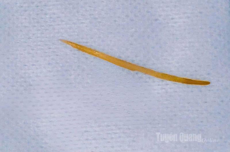 Tulang ikan, kira-kira 5 cm panjang, telah dikeluarkan dari duodenum pesakit.