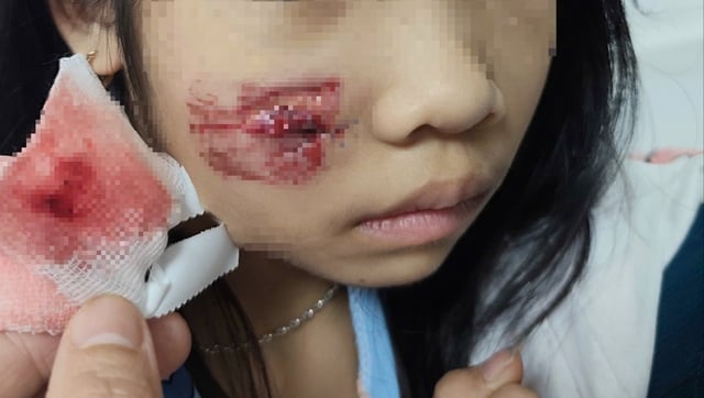 Ребенок получил сложные травмы лица и головы в результате нападения обезьяны - Фото 1. Cháu bé bị khỉ tấn công gây vết thương phức tạp vùng mặt, đầu- Ảnh 1.