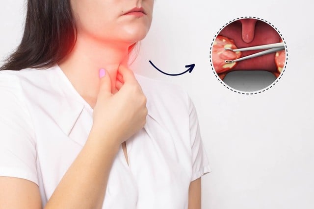 ເມື່ອຕ່ອມທອນຊິນໃຄ່ບວມ (ໂດຍປົກກະຕິແລ້ວແມ່ນລະດັບ 3 ຫຼື 4), ມັນສາມາດລົບກວນກິດຈະກໍາປະຈໍາວັນໄດ້ຢ່າງຮ້າຍແຮງ. Khi amidan sưng to (thường là độ 3, độ 4) gây cản trở nghiêm trọng đến chức năng sinh hoạt