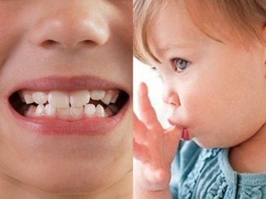 Điều trị sớm khớp cắn ngược răng sữa ở trẻ- Ảnh 1.