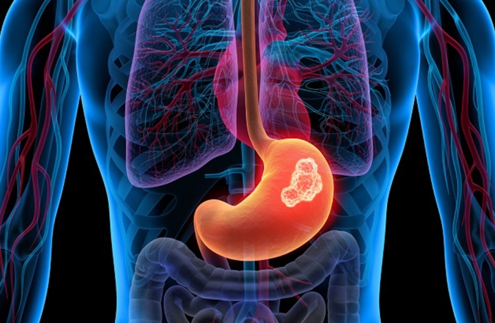 5 complicazioni comuni del cancro allo stomaco che dovresti conoscere - Immagine 1.
