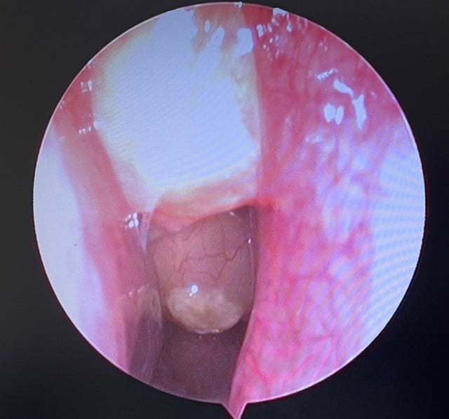 ការវះកាត់ដោយជោគជ័យសម្រាប់អ្នកជំងឺដែលមានដុំសាច់ក្នុងច្រមុះទាំងសងខាង រលាកប្រហោងឆ្អឹងច្រមុះ និងជំងឺធ្ងន់ធ្ងរមួយចំនួន - រូបភាពទី 1។ Phẫu thuật thành công cho bệnh nhân polyp mũi hai bên, viêm mũi xoang kèm hàng loạt bệnh lý nền nặng - Ảnh 1.