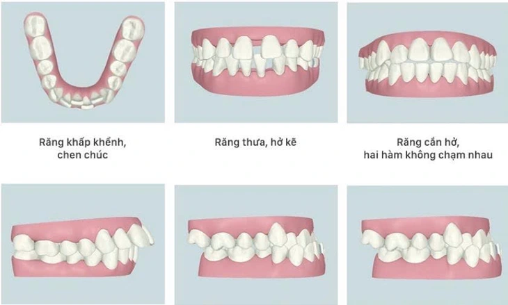 sâu răng - Ảnh 1.