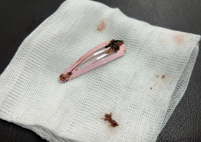 ក្មេងស្រីអាយុ ៦ ឆ្នាំម្នាក់ត្រូវបានបញ្ជូនទៅមន្ទីរពេទ្យដើម្បីព្យាបាលជាបន្ទាន់ បន្ទាប់ពីលេបក្លីបសក់ដែកមួយ - រូបថតទី ១។ Bé 6 tuổi nhập viện cấp cứu vì nuốt kẹp tóc kim loại- Ảnh 1.