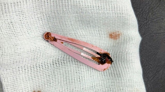 Ngủ trưa bé gái 6 tuổi nuốt kẹp tóc dài 7 cm vào ổ bụng - Ảnh 1.