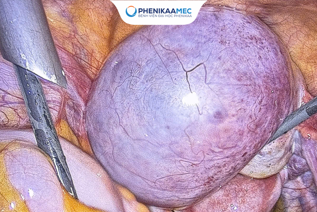 6 nejčastěji přehlížených příznaků cyst na vaječnících u žen - Obrázek 1.