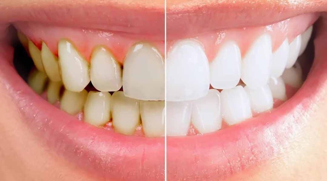 4 corrette pratiche di igiene orale per i pazienti affetti da malattia parodontale - Immagine 1.