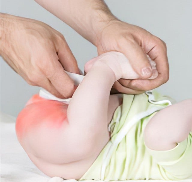 Hăm tã ở trẻ nhỏ: Mẹ cần xử lý thế nào?- Ảnh 1.