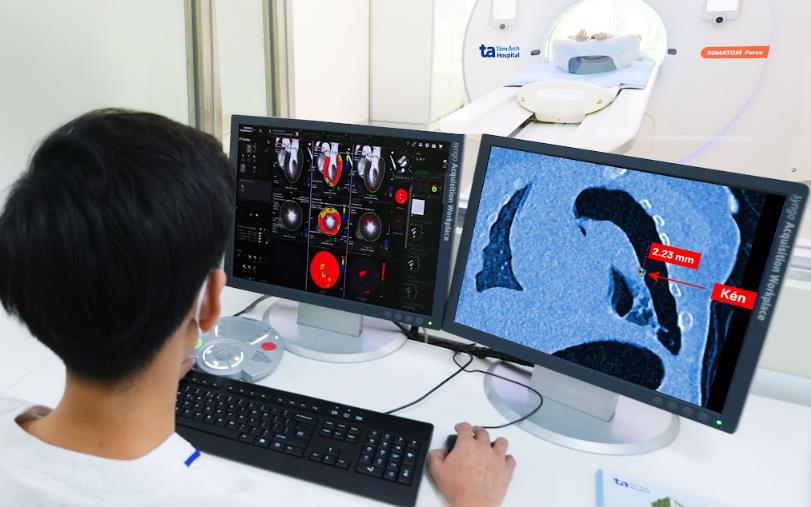 The image taken on the Somatom Force VB30 CT machine shows a ruptured lung cyst with a super small diameter of only about 2mm in the child patient. Photo: Tam Anh General Hospital