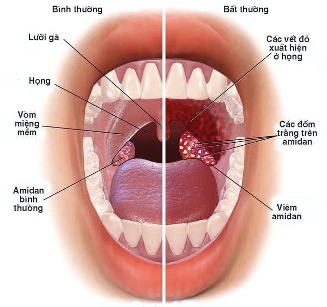 Cách phòng ngừa viêm họng, đau họng khi trời lạnh đơn giản mà hiệu quả - Ảnh 3.