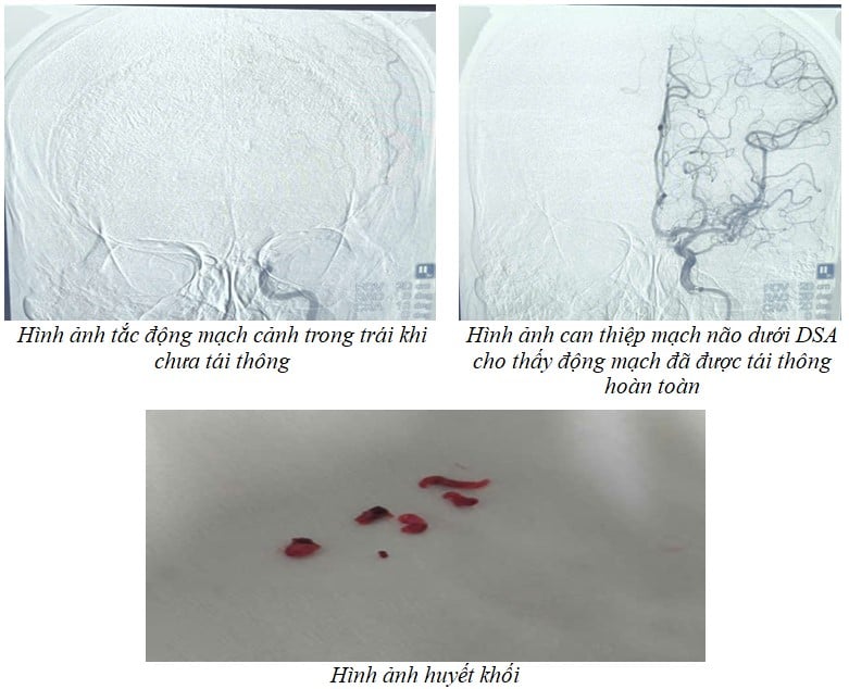 Tin vui cho người đàn ông 31 tuổi ở Phú Thọ đang khỏe mạnh bất ngờ liệt nửa người, đột quỵ do nhồi máu não - Ảnh 3.