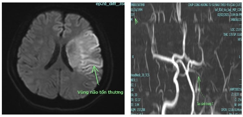 Tin vui cho người đàn ông 31 tuổi ở Phú Thọ đang khỏe mạnh bất ngờ liệt nửa người, đột quỵ do nhồi máu não - Ảnh 2.