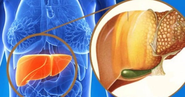 How dangerous is fatty liver disease? Do this immediately after Tet to prevent the disease