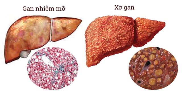 Bệnh gan nhiễm mỡ nguy hiểm thế nào? Sau Tết làm ngay điều này để phòng bệnh - Ảnh 2.