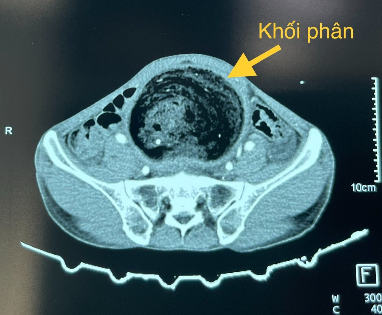 Người đàn ông bụng to như chửa sau 3 năm thường xuyên bị táo bón- Ảnh 1.