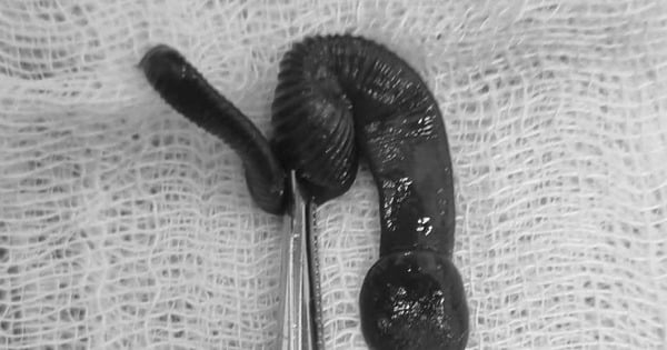 A 37-year-old man in Nghe An has an 8cm leech living in his nose, admitting to something many men often do.