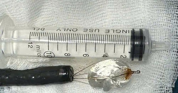 Un garçon de 11 ans avale le bouchon d'une canette de soda, provoquant une obstruction gastrique