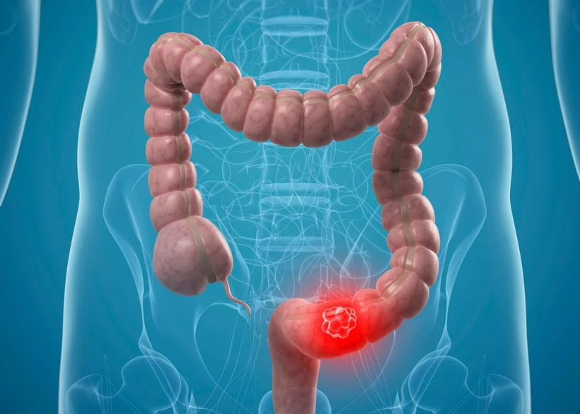 Une application d'IA identifie le cancer du côlon à partir d'une analyse d'échantillons histopathologiques