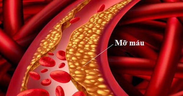 旧正月後の脂質異常症に注意、50歳未満は知っておきたい