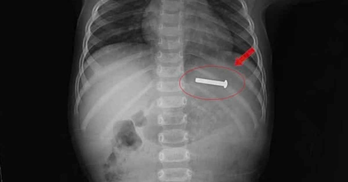 5cm long screw removed from 15-month-old child's stomach