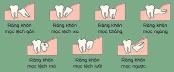 Răng khôn khi nào cần nhổ, nên nhổ ở độ tuổi nào? - Ảnh 2.