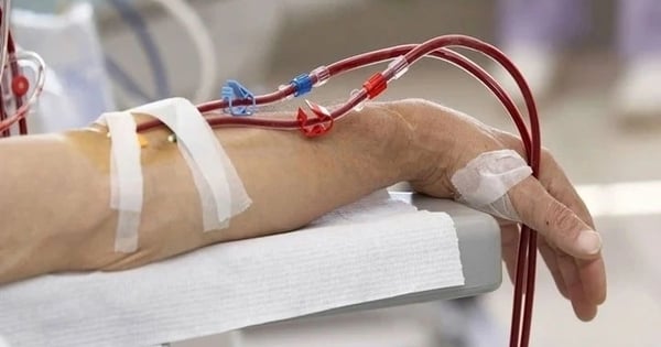 Can "super-tech blood filtration" prevent stroke?