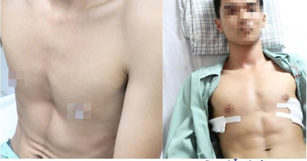 Un garçon de 19 ans a parcouru près de 2 000 km pour soigner un pectus excavatum congénital, des résultats au-delà des attentes !