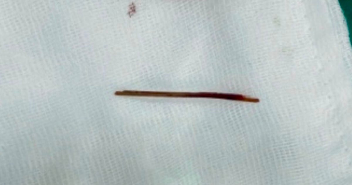 5cm long toothpick found stuck in patient's liver