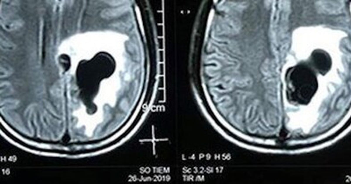 Déformation de la bouche due à des vers nichés dans le cerveau : causée par le plat préféré des Vietnamiens