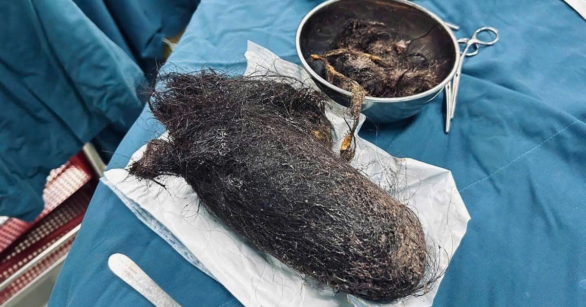 Extraen una bola de pelo gigante de casi 1 kg del estómago de una niña de 12 años