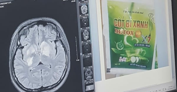 Another girl suffers brain damage from using weight loss products containing banned substances