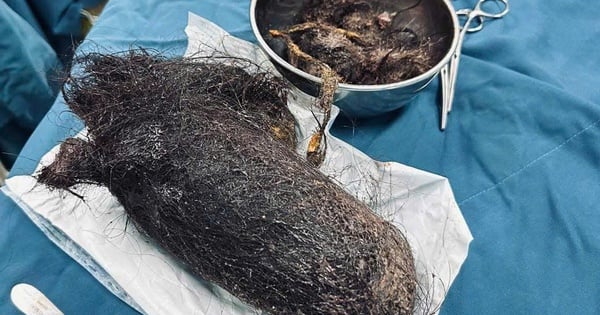 A hair bun weighing nearly 1kg was found blocking the stomach of a 12-year-old girl.