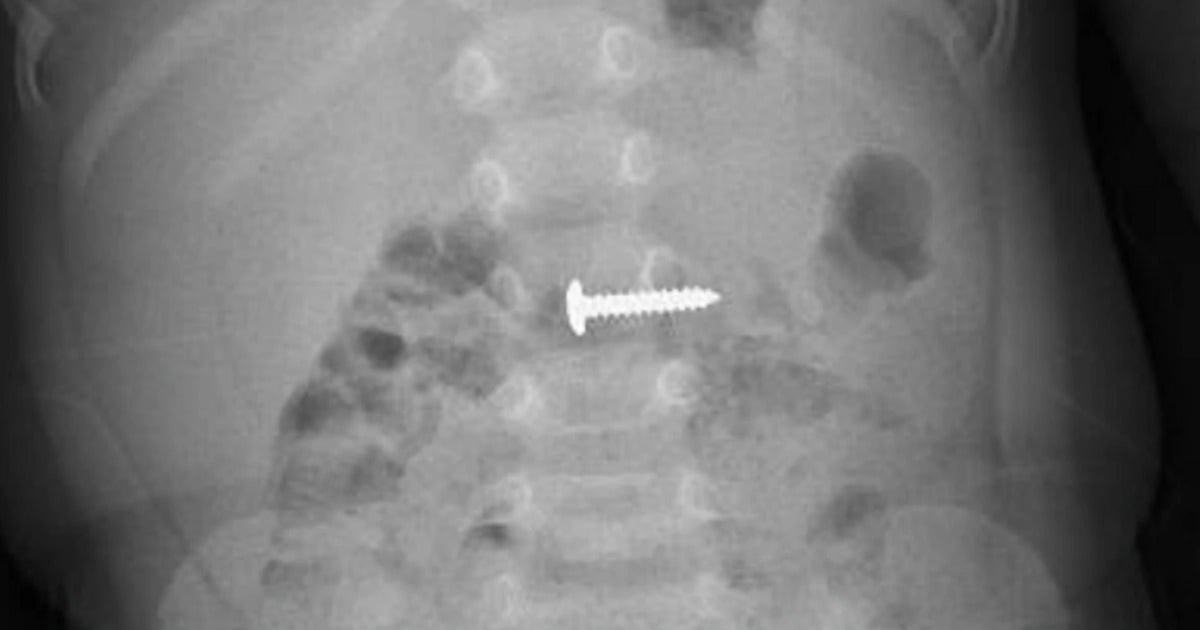 3 year old boy swallowed a screw