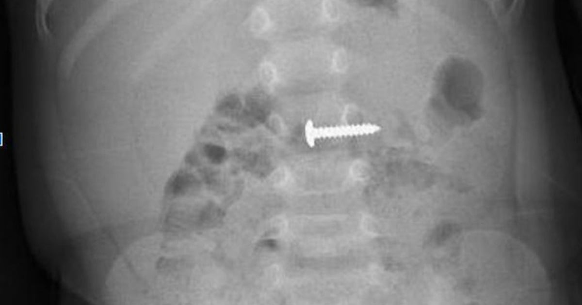 Save the child who swallowed a sharp screw