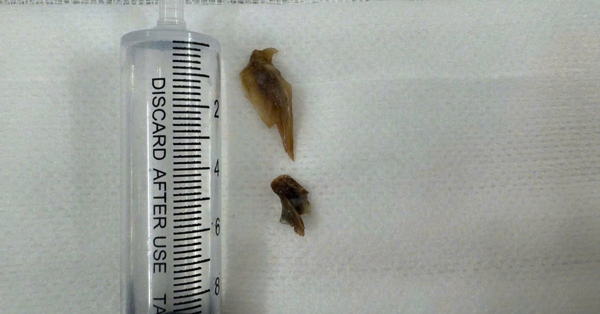 Bone fragments found in man's lungs for more than 2 years