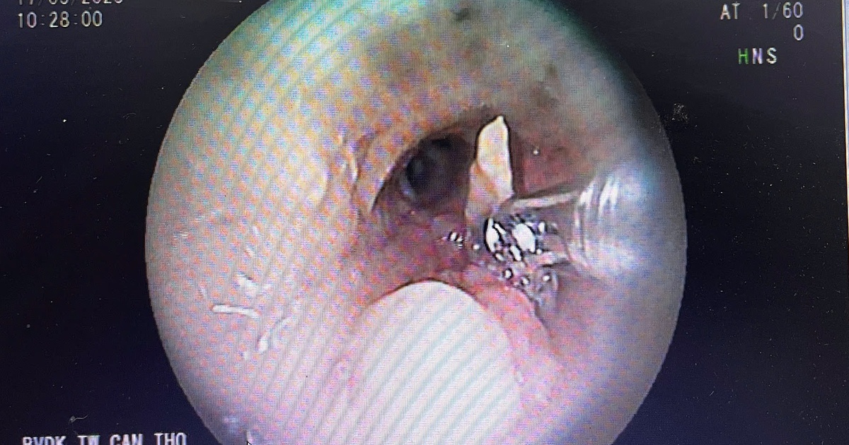 Rare: Duck bone stuck in bronchus, only removed after 2 years