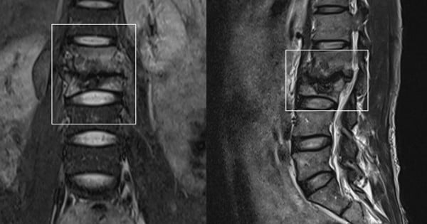 Un hombre de 39 años acudió al médico por un dolor de espalda y se sorprendió al descubrir que había perdido 2 vértebras.