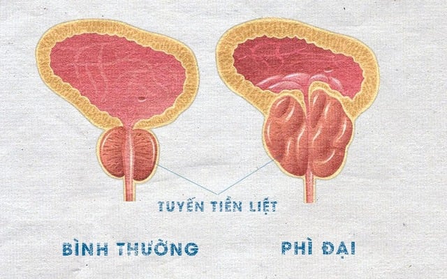 Người đàn ông không thể tiểu tiện vì bị u tiền liệt tuyến, nam giới sau 50 tuổi có dấu hiệu này cần cảnh giác- Ảnh 3.