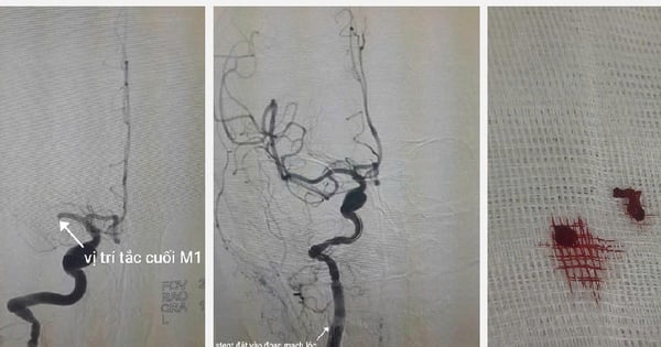 Во время готовки у женщины внезапно случился инсульт.