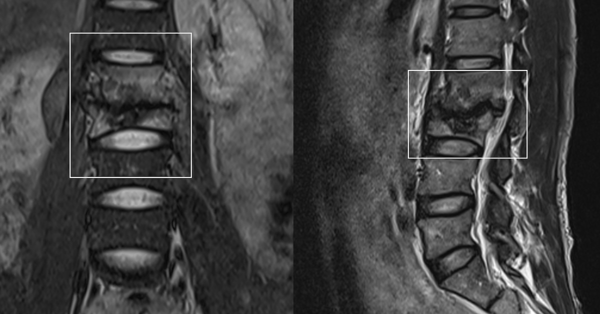 Mal de dos, un homme stupéfait lorsqu'on lui découvre une tuberculose vertébrale