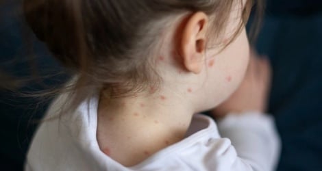 Prevent cross-infection to avoid the painful lesson of the 2014 measles epidemic