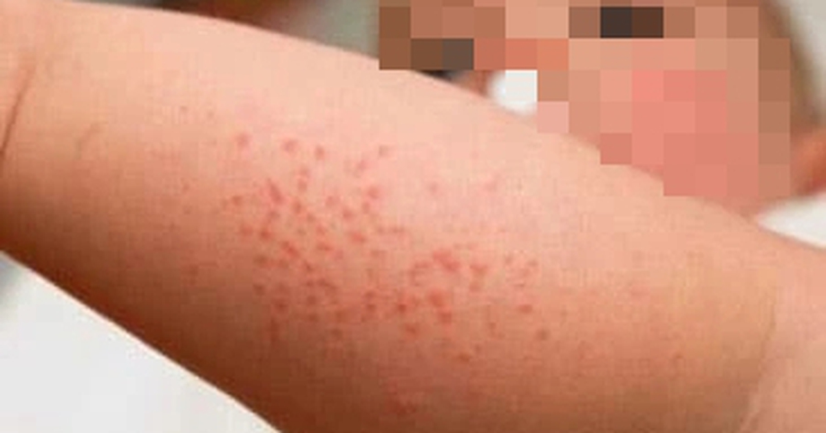 Hanoi: Girl dies from measles